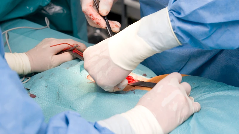 Các yếu tố quyết định mổ thoát vị bẹn bao lâu thì đi lại được