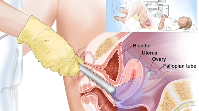 Mới có bầu có nên siêu âm đầu dò không? Giải đáp chính xác từ chuyên gia 2
