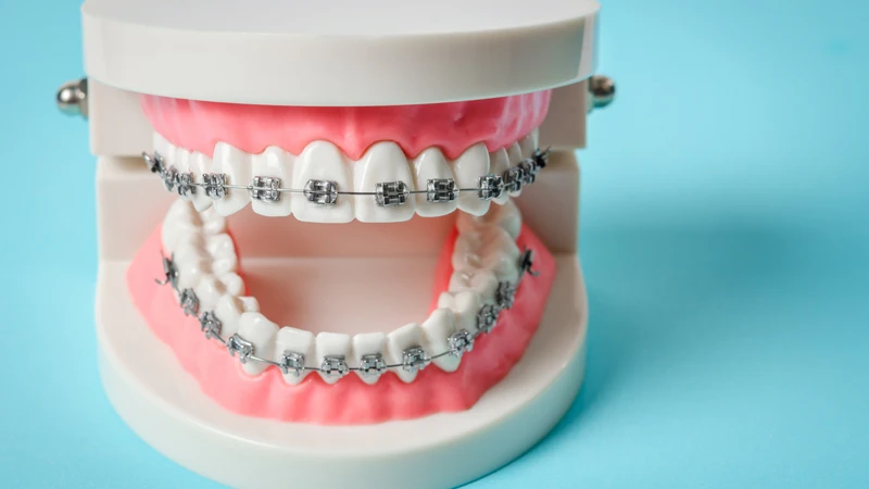 Mức độ đau khi niềng răng phụ thuộc vào nhiều yếu tố khác nhau