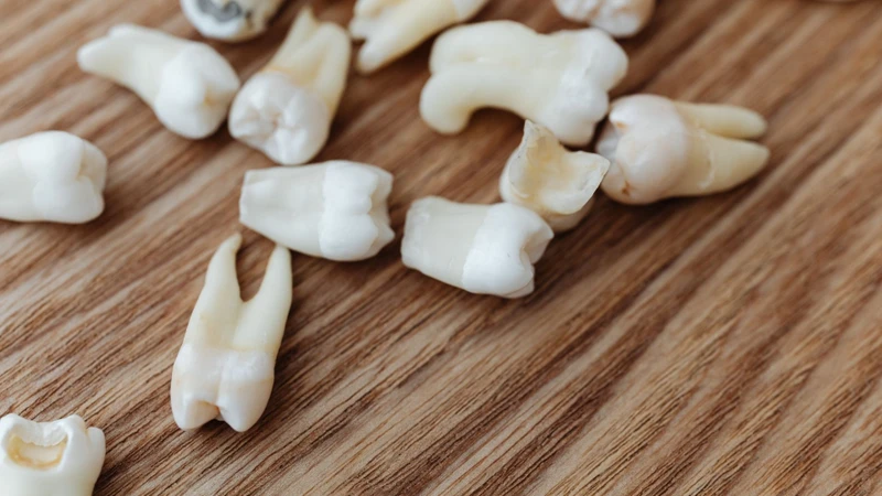 Mòn răng có thể do tác nhân cơ học khi nhai thức ăn cứng