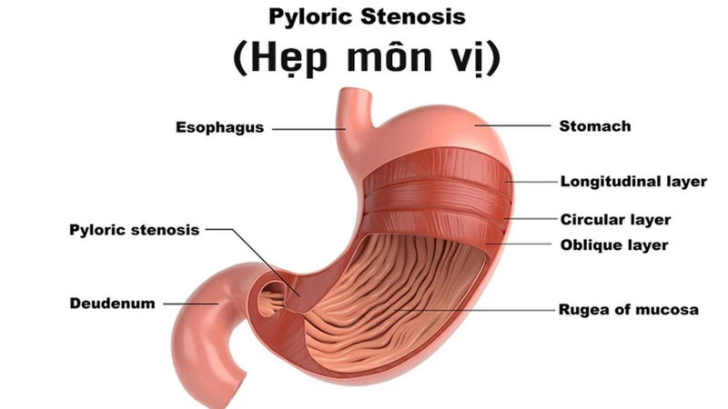 Hẹp môn vị có thể gây ra rối loạn chuyển hóa nghiêm trọng