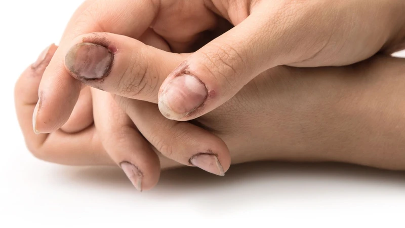 Một số bệnh lý có thể khiến bề mặt móng trở nên sần sùi