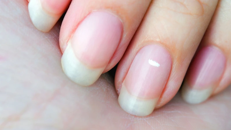 Móng tay có vết trắng thiếu chất gì? Thiếu vi chất chỉ là một nguyên nhân có thể gặp