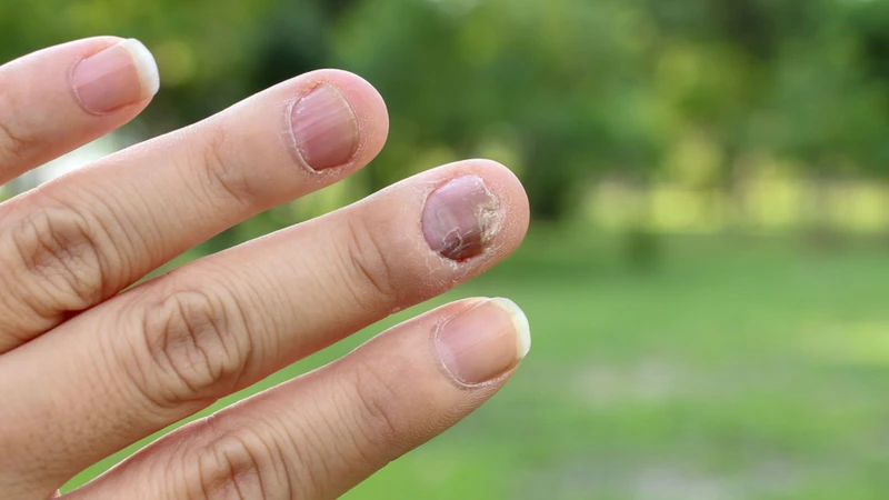Nhiễm nấm móng có thể là nguyên nhân dẫn đến hiện tượng móng tay trắng đục