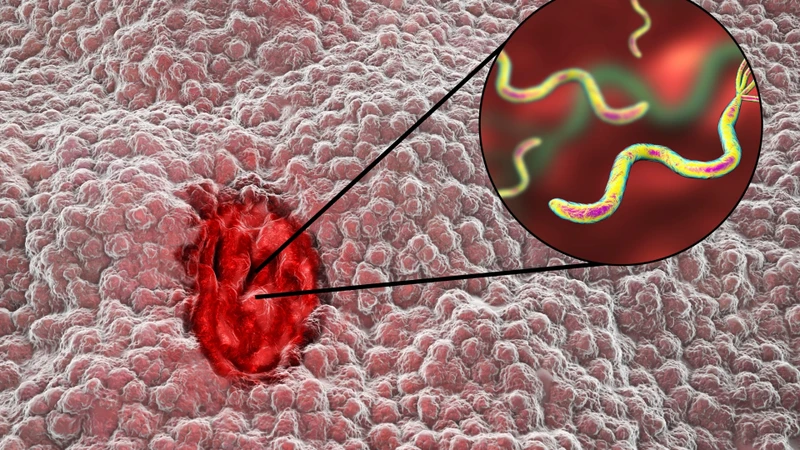 Nhiễm H. pylori là một trong những nguyên nhân hàng đầu gây viêm và loét dạ dày