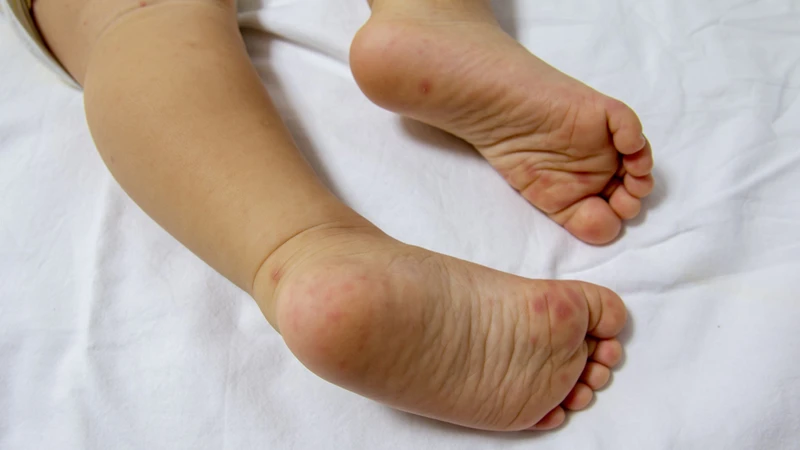 Phụ huynh cần chú ý các dấu hiệu sớm như sốt, loét miệng, phát ban dạng mụn nước ở tay, chân trẻ