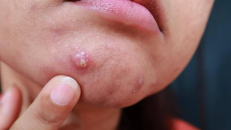 Mụn bọc mủ là tình trạng mụn viêm năng