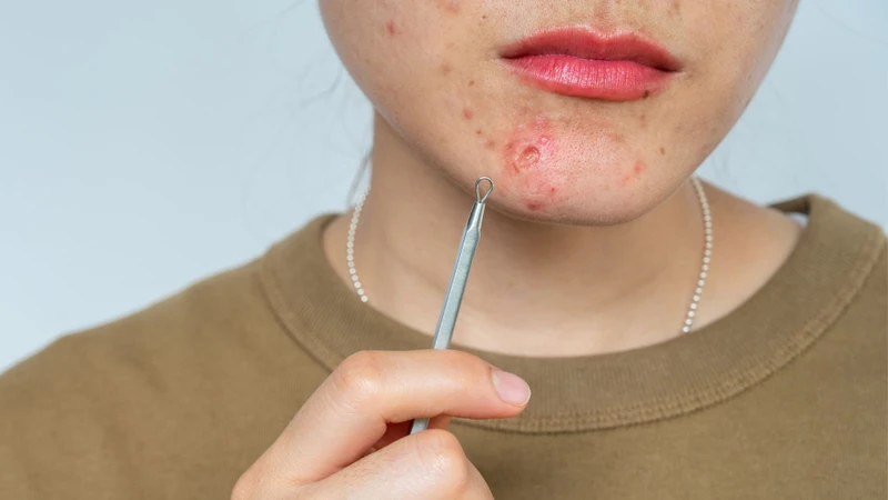 Mụn bọc ở cằm thường biểu hiện bằng nốt sưng viêm đỏ, đau và dễ để lại sẹo nếu xử lý sai cách