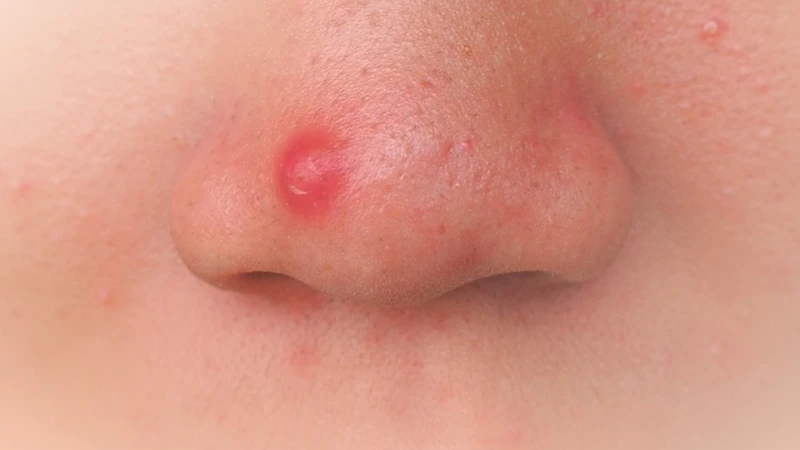Mụn bọc ở mũi giai đoạn nặng gây sưng to, đỏ lan cánh mũi, đau nhức và nóng rát
