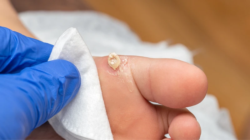 Mụn cóc có nguy hiểm không? Chẩn đoán và điều trị mụn cóc 2