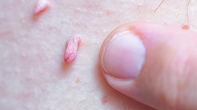 Mụn cóc hậu môn là gì? Biện pháp phòng ngừa bệnh mụn cóc hậu môn 1