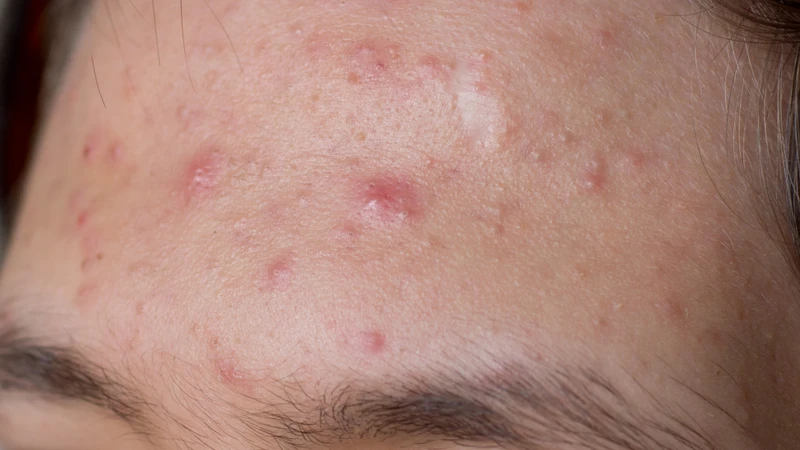 Mụn dậy thì: Nguyên nhân và cách điều trị an toàn 2