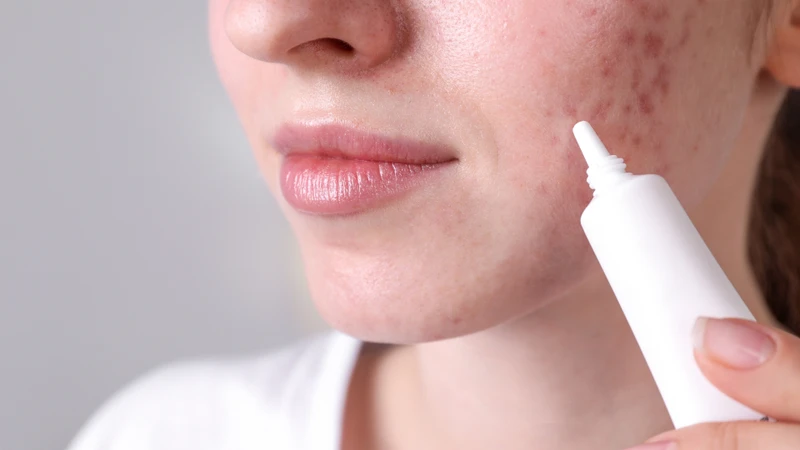 Mụn dậy thì: Nguyên nhân và cách điều trị an toàn 4