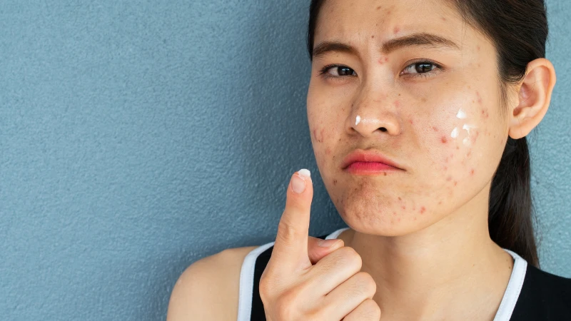 Mụn dị ứng: Dấu hiệu, nguyên nhân và cách xử lý hiệu quả 2