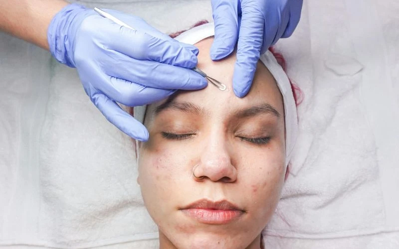 Nặn mụn đúng cách và đảm bảo vô trùng giúp tình trạng cải thiện tốt hơn