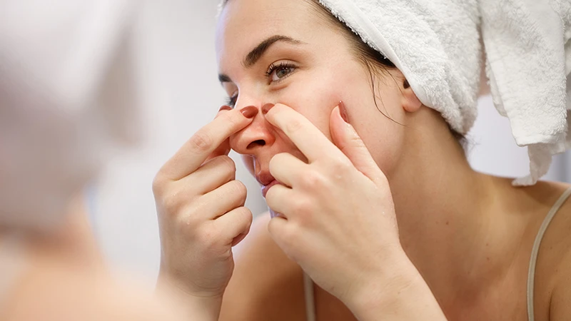 Mụn mủ có nên nặn không​ là vấn đề nhiều người thắc mắc khi gặp tình trạng này