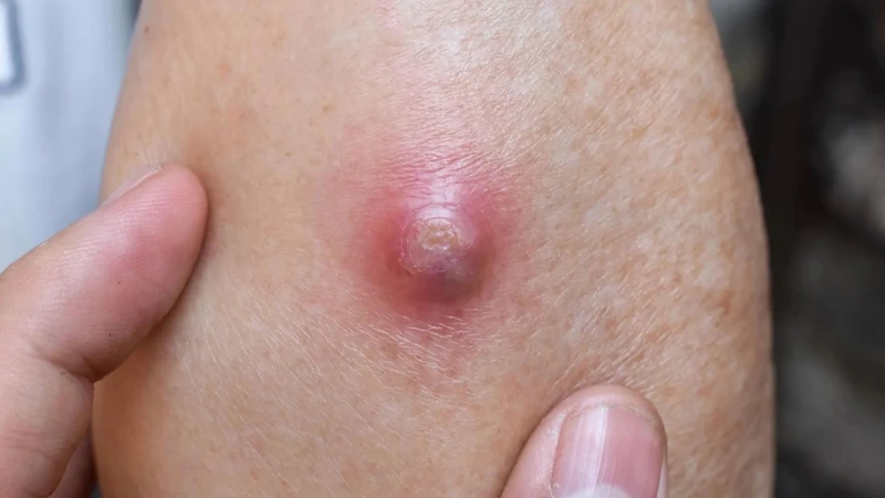 Mụn nhọt là gì? Nguyên nhân, triệu chứng và cách điều trị 2