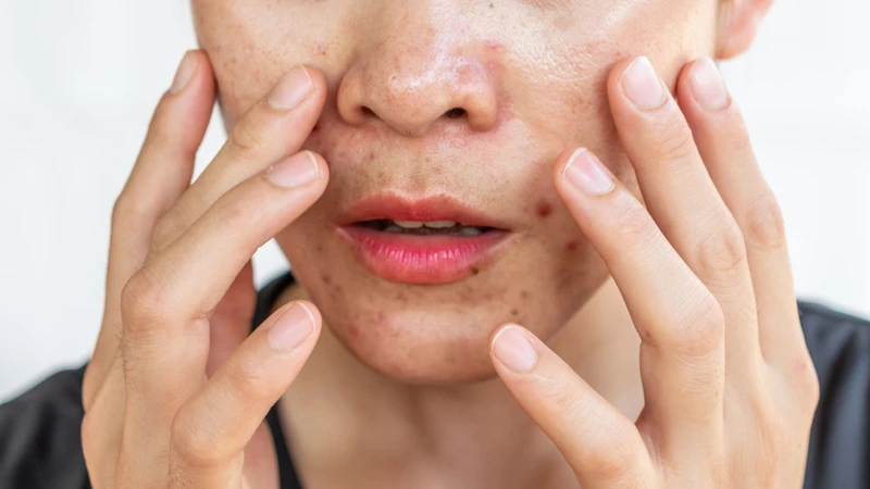 Mụn nhọt bị nhiễm trùng: Nhận biết sớm và chăm sóc đúng cách để tránh biến chứng 4
