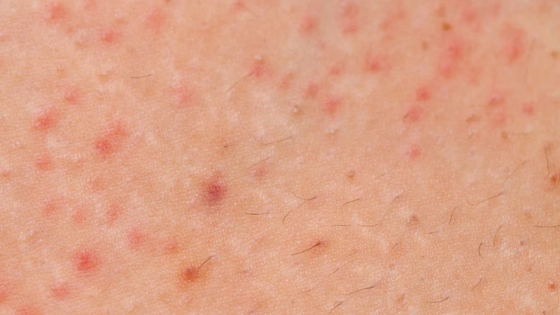 Mụn nhọt ở chân trẻ: Nguyên nhân, dấu hiệu và cách điều trị hiệu quả 1