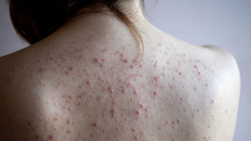 Mụn nhọt ở lưng: Bệnh ngoài da thường gặp và cách xử lý 1