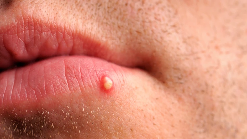 Mụn nhọt ở môi: Dấu hiệu nhận biết, nguyên nhân và cách xử lý đúng cách 1