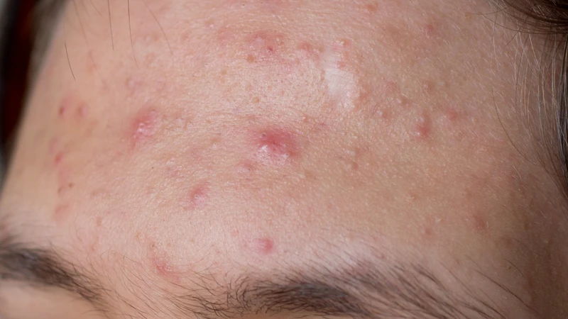 Mụn nhọt ở trán: Nguyên nhân, cách phòng ngừa và khi nào cần đi khám? 1