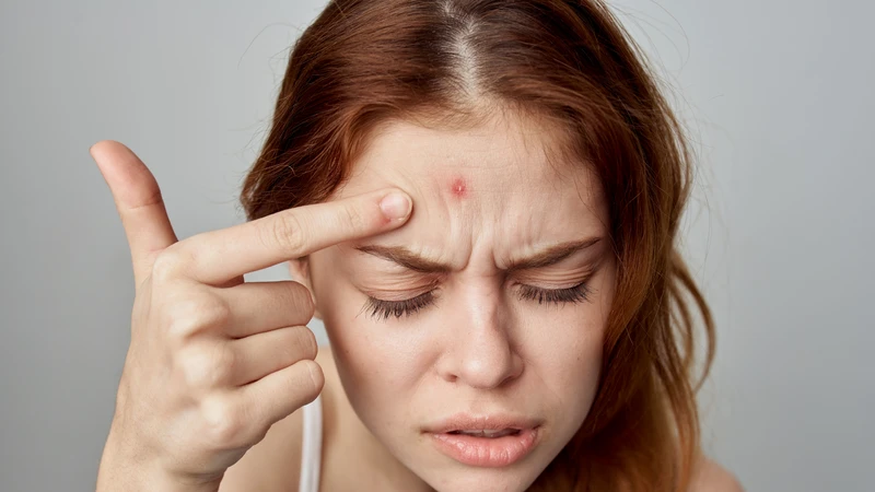 Mụn nhọt ở trán: Nguyên nhân, cách phòng ngừa và khi nào cần đi khám? 2