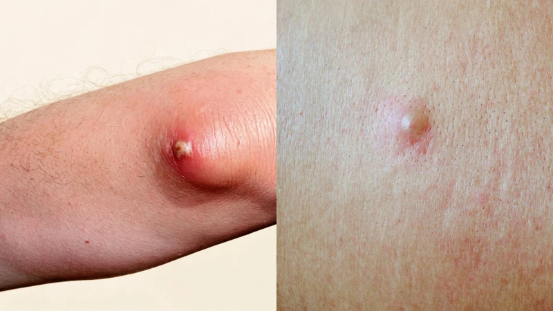 Mụn nhọt và áp xe da có nhiều điểm tương đồng nhưng khác nhau về kích thước, mức độ đau và phạm vi tổn thương