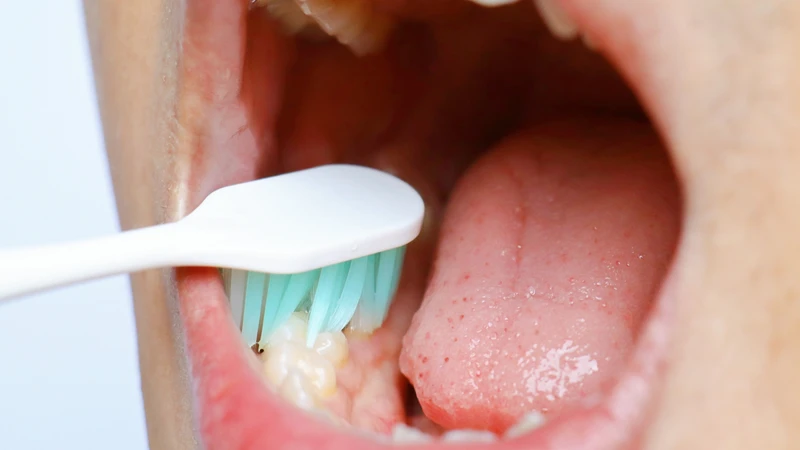 Vệ sinh răng miệng đúng cách giúp giảm kích ứng niêm mạc