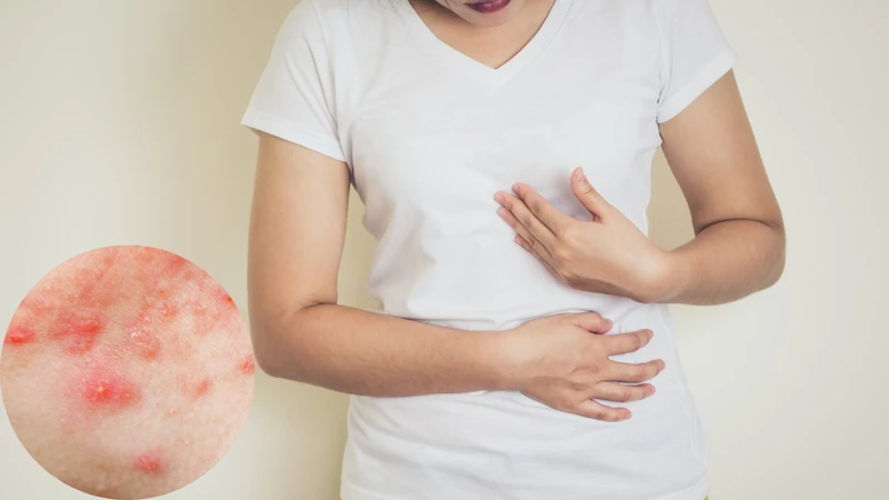 Mụn ở ngực: Nguyên nhân, cách điều trị và phòng ngừa hiệu quả 3