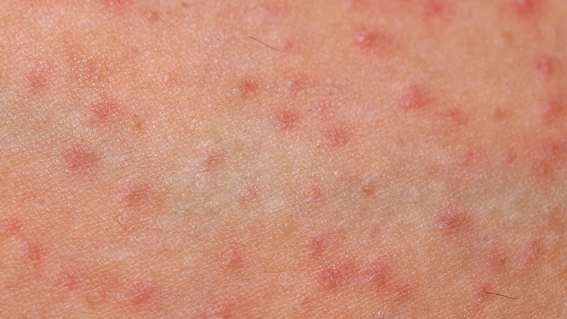 Mụn rộp sinh dục ban đầu dễ nhầm với mụn viêm hoặc kích ứng da