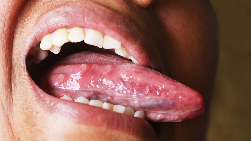 Herpes lưỡi có thể gây mụn nước nhỏ, đau rát và loét trong miệng