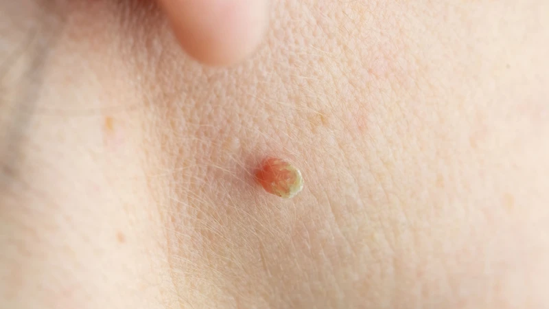 Mụn thịt là gì? Triệu chứng, nguyên nhân, chẩn đoán và điều trị 1