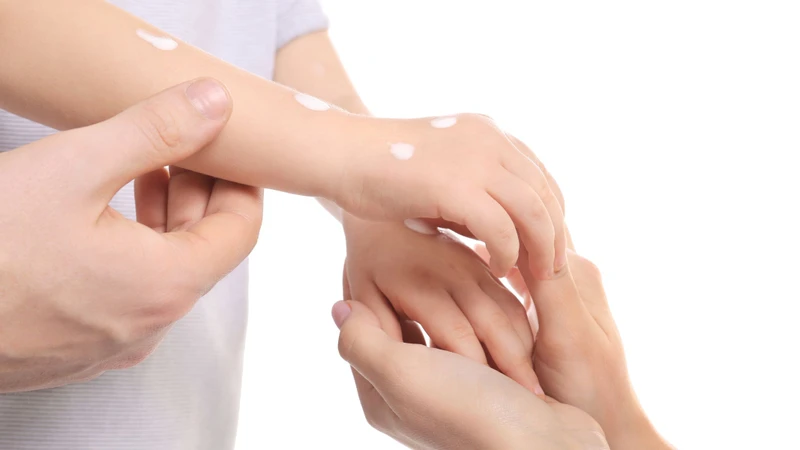 Muỗi đốt bôi gì? Cách giảm ngứa khi bị muỗi đốt hiệu quả nhất 4