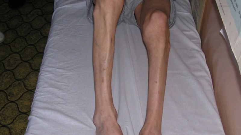 Myostatin ảnh hưởng đến khối lượng cơ thông qua cơ chế kiểm soát sự phát triển cơ
