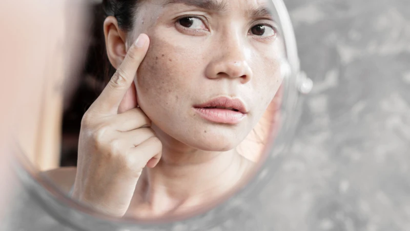 Các đốm nám chân sâu thường có màu nâu sẫm hoặc xám, xuất hiện rõ ở vùng gò má