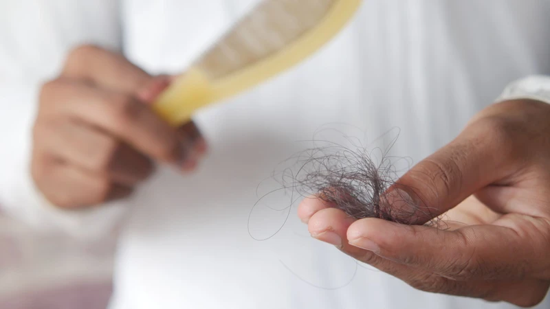 Rụng tóc là triệu chứng thường gặp của nấm da đầu