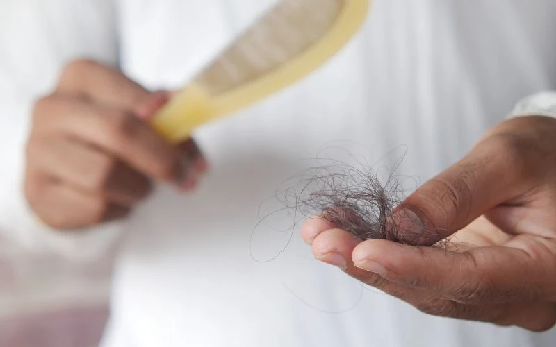 Nấm da đầu có thể dẫn đến viêm nhiễm, rụng tóc, ảnh hưởng thẩm mỹ người bệnh
