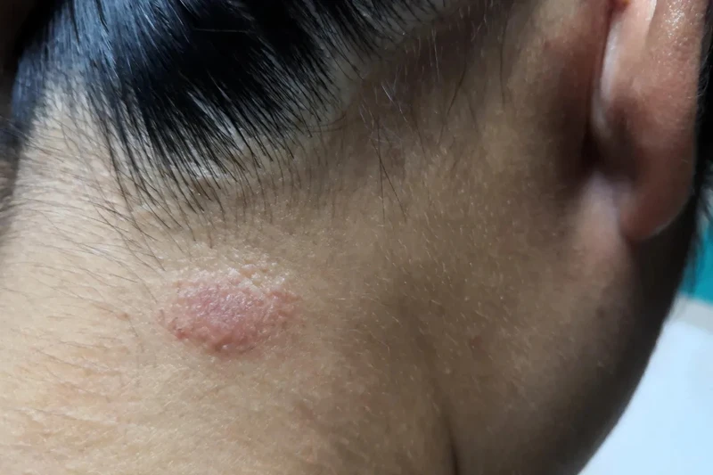 Nấm da đầu và gàu khác nhau như thế nào cần dựa vào vị trí xuất hiện, tính chất cũng như hậu quả để phân biệt