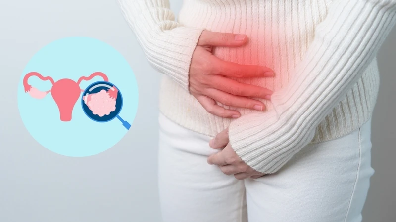 Nang buồng trứng trái: Nguyên nhân, dấu hiệu và mức độ nguy hiểm bạn cần biết 1