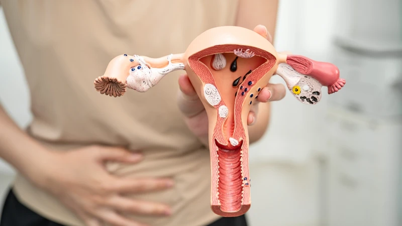 Nang buồng trứng trái: Nguyên nhân, dấu hiệu và mức độ nguy hiểm bạn cần biết 3