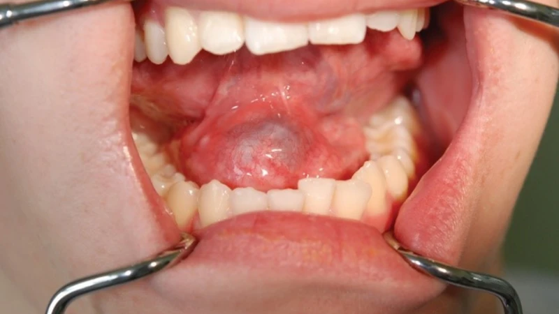 Hình ảnh khối sưng phồng điển hình của nang nhái sàn miệng