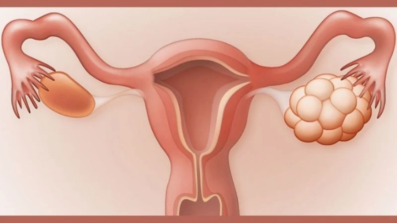 Hội chứng buồng trứng đa nang có thể làm rối loạn sự phát triển nang noãn và rụng trứng