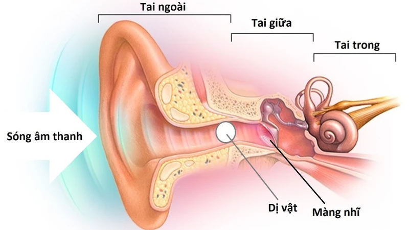 Nghe kém là gì? Bệnh có thể hồi phục hay không 3.jpeg