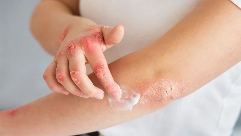 Ngộ độc corticoid xảy ra khi cơ thể chịu ảnh hưởng quá mức của thuốc