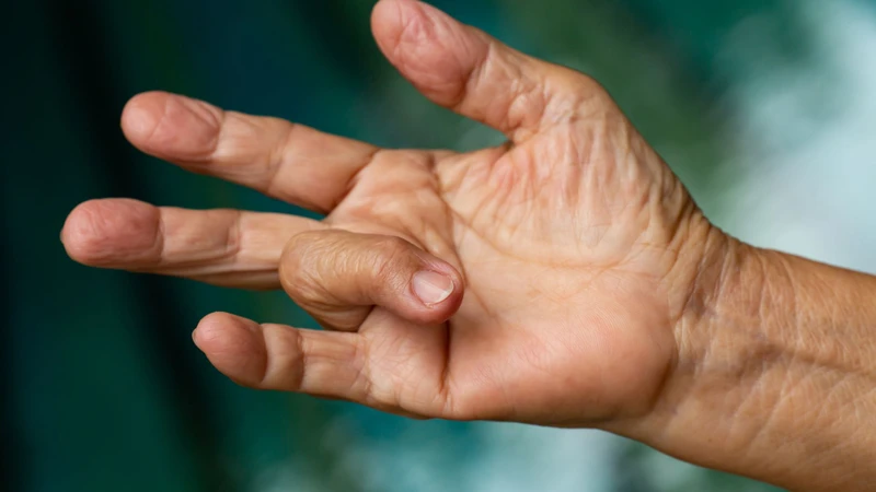 Ngón tay cò súng là tình trạng viêm và dày lên của bao gân gấp ngón tay