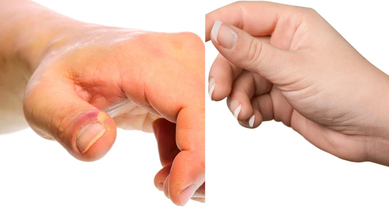 So sánh sự khác biệt giữa ngón tay bình thường và ngón tay có biến đổi ở đầu ngón