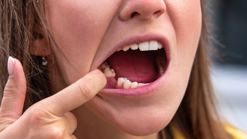 Nguyên nhân khiến một người chỉ có 24 cái răng là do đã mất răng do bệnh lý và chấn thương