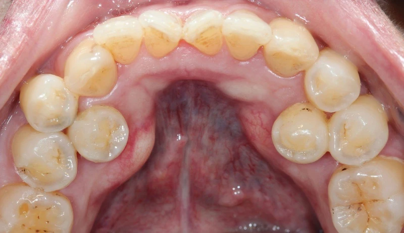 Người có 36 cái răng có thể bị ảnh hưởng nếu răng thừa gây chen chúc hoặc khó vệ sinh