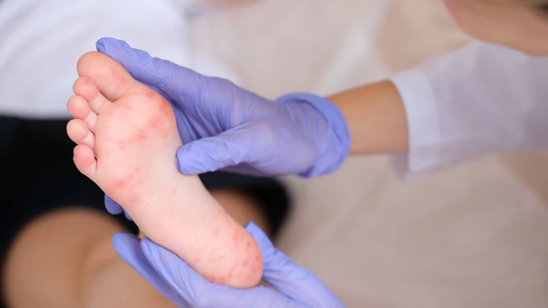 Người lớn có bị tay chân miệng không? Người lớn có thể bị tay chân miệng